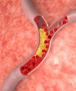 blocked artery