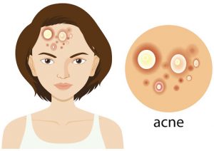 acne infographic
