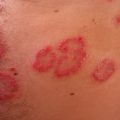 plaque psoriasis