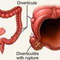 diverticula graphic