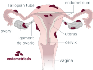 endometriosis graphic