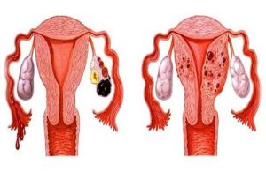endometriosis pre and post