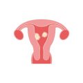 uterus with fibroids illustration