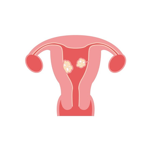 uterus with fibroids illustration