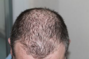 thinning hair