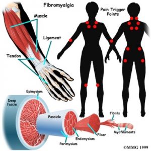 fibromyalgia graphic