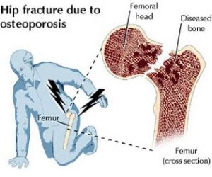 femur fracture osteoporosis