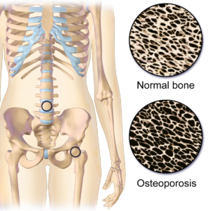 osteoporosis vs normal bone
